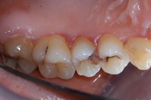 caries, tooth decay, cavities: floss could have prevented this