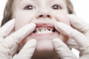 child with black teeth aka early childhood caries. Join the TeethFirst revolution