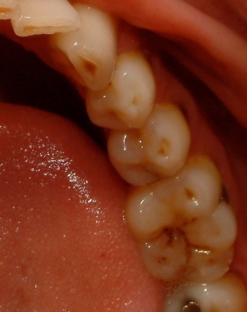 Dental Erosion Posterior Teeth