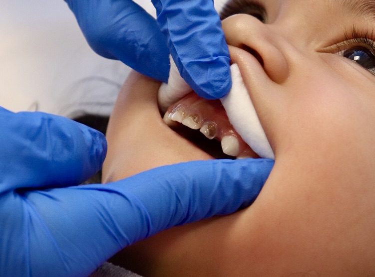 A person is getting their teeth checked by an dentist.