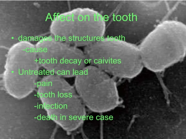 A black and white photo of tooth decay.