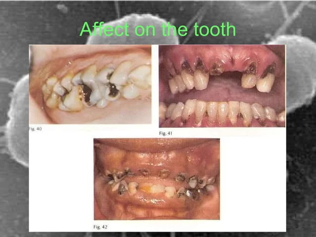 A picture of teeth with different stages of tooth decay.