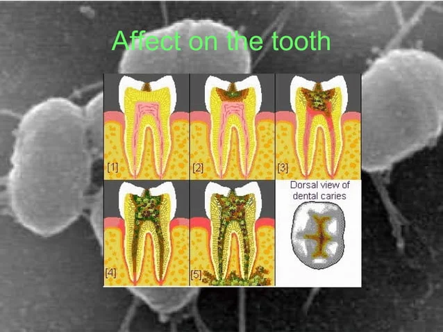 A series of photos showing the effects of dental caries.