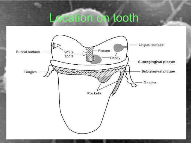 A diagram of the location on tooth.