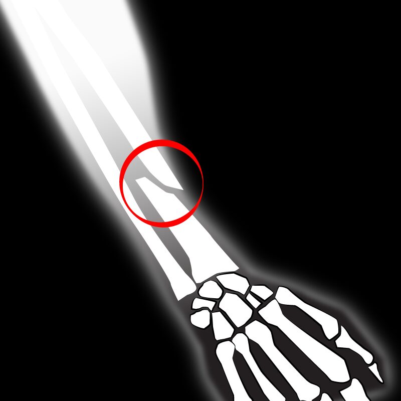 A skeleton arm with a red circle around it.