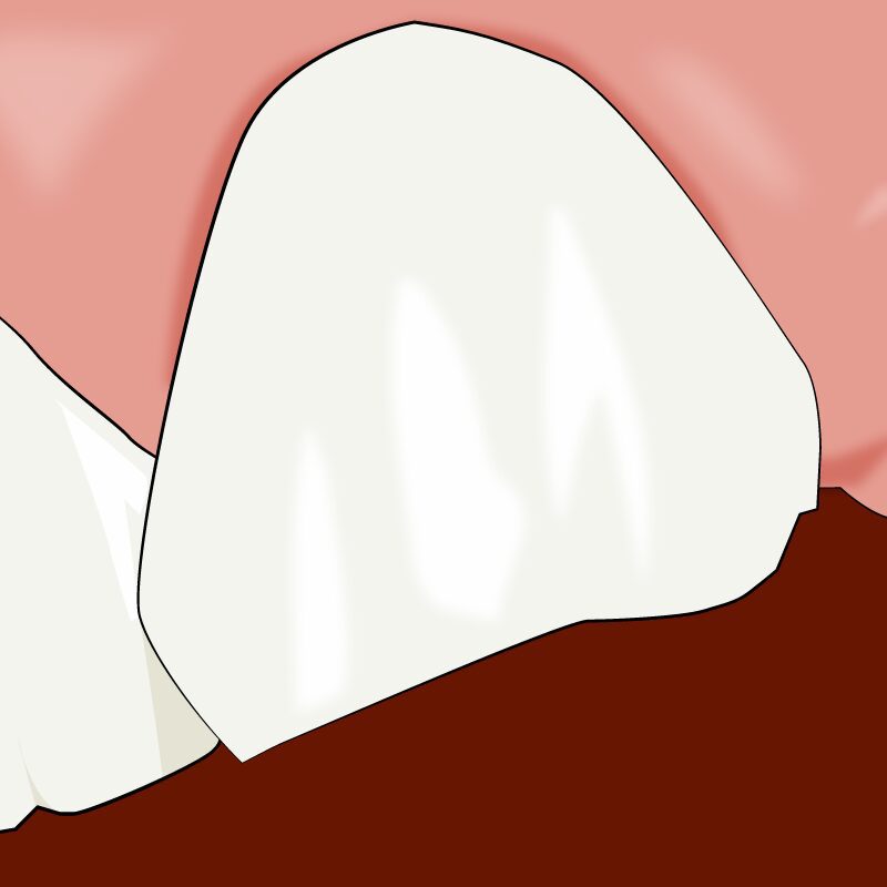 A cartoon of teeth with white fillings on them.