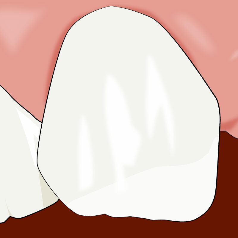 A cartoon of teeth with white fillings on them.