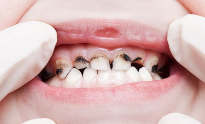 A person with black spots on their teeth.