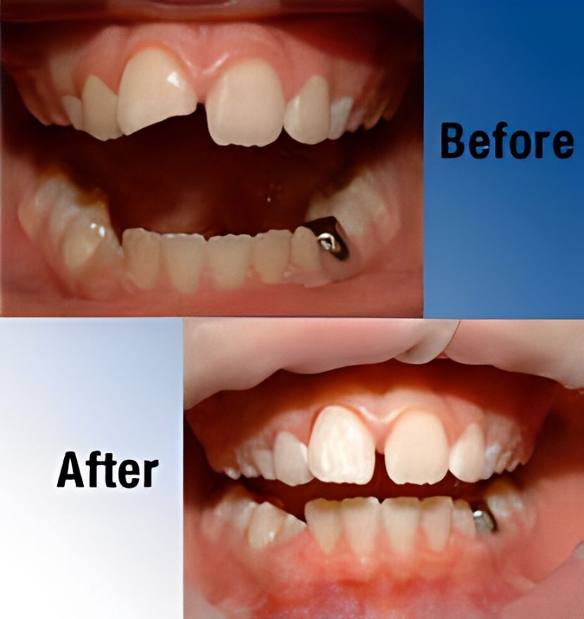 A before and after picture of the teeth with missing tooth.